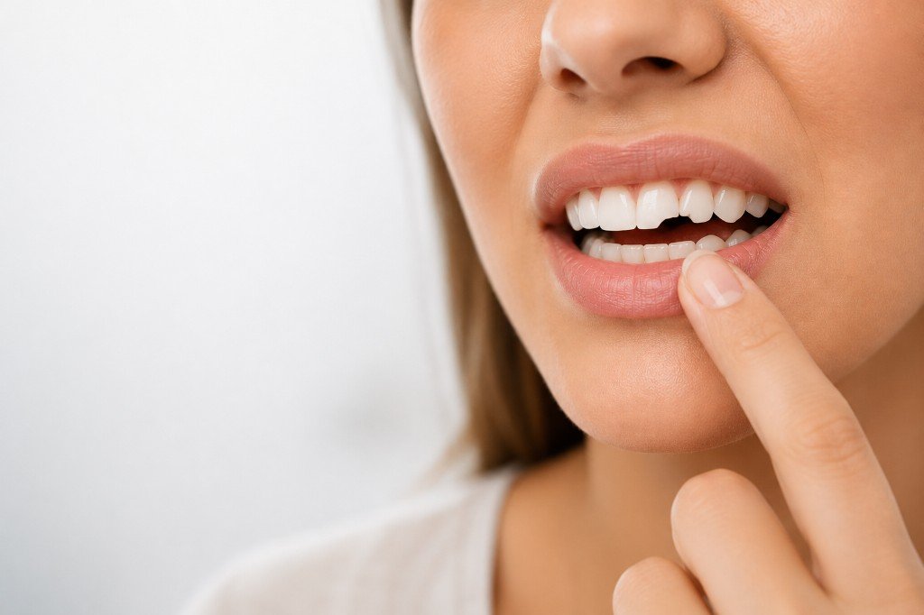 Broken or Chipped Tooth at Lawrence Park Dentistry