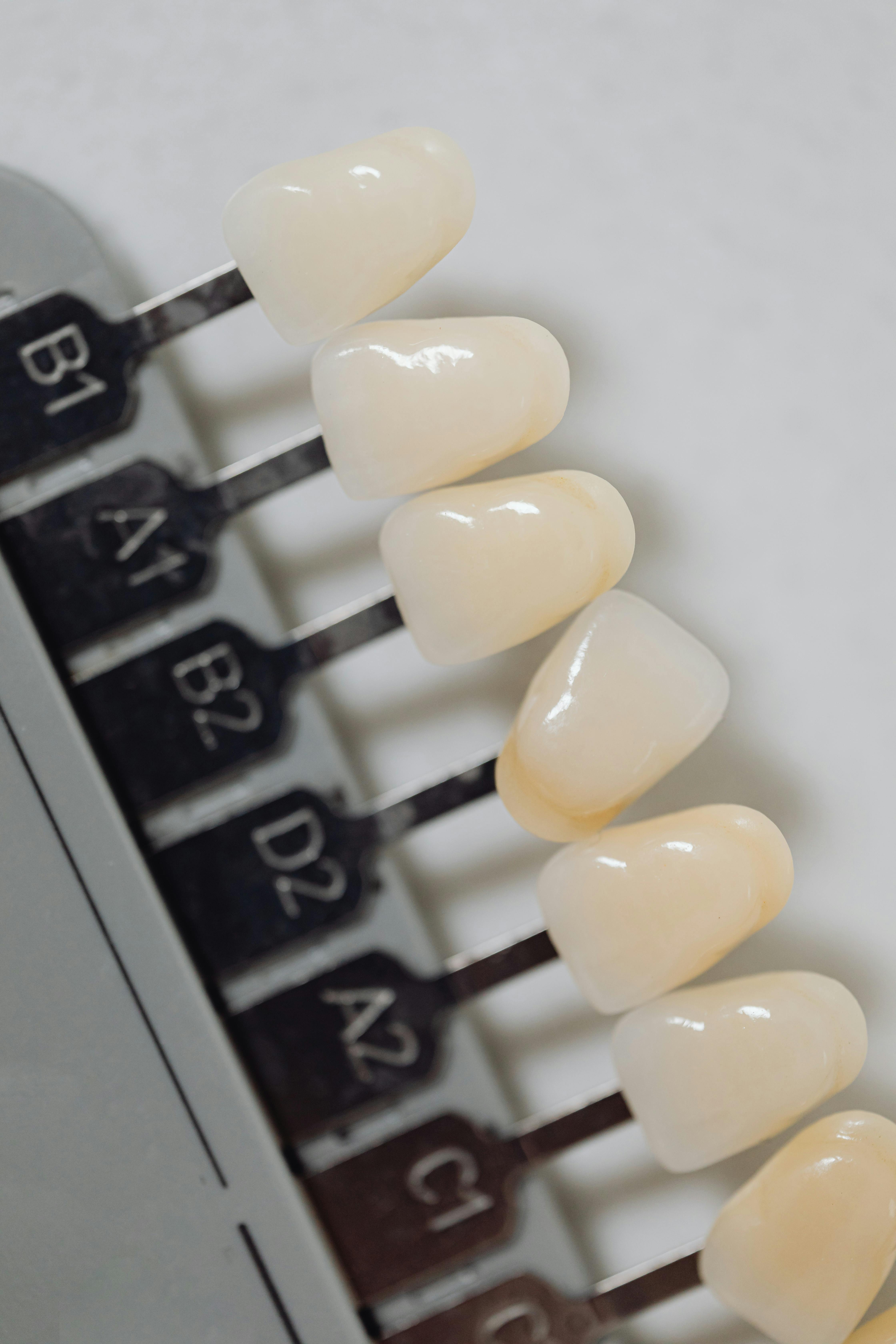 Inlays & Onlays at Lawrence Park Dentistry