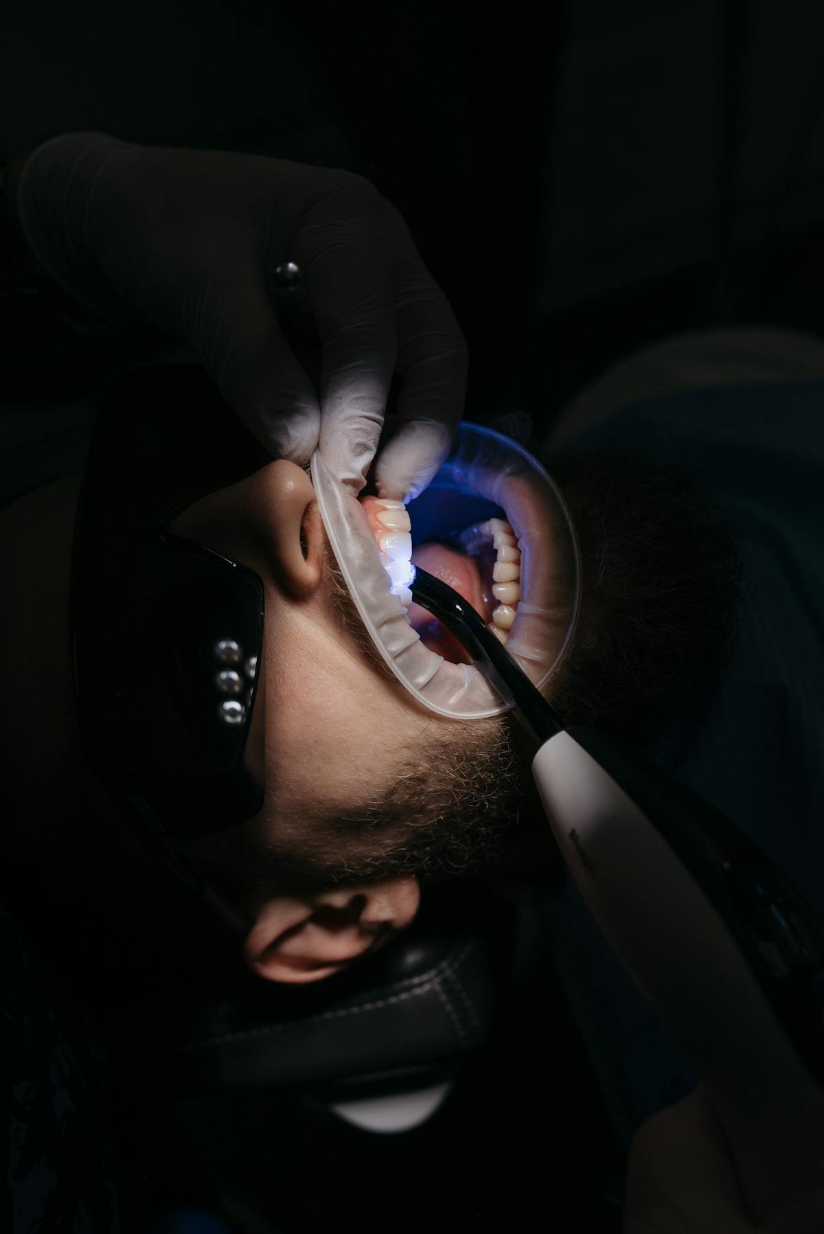 Tooth-Coloured Fillings at Lawrence Park Dentistry