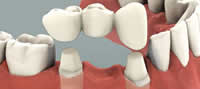 dental-bridges