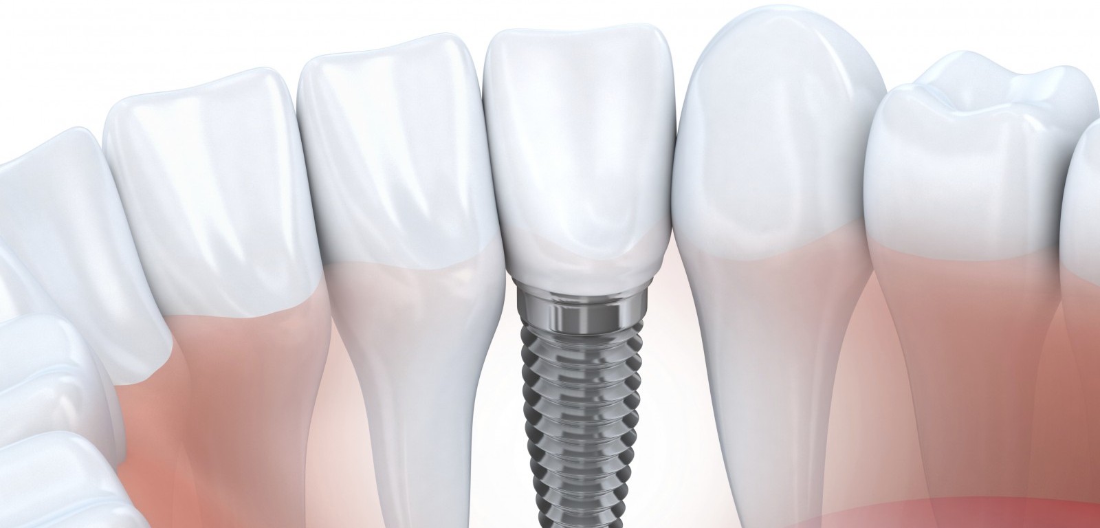 Dental implants